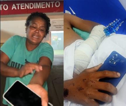 Adolescente internado em hospital de Várzea Grande tem larvas em ferimento após acidente